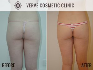 Before & After Images - Liposuction