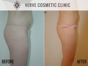 Before & After Photo - Liposuction