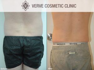 Liposuction Verve
