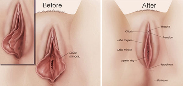 labiaplasty_treatment