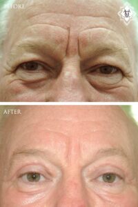 Blepharoplasty-10