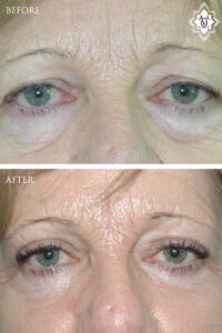 Blepharoplasty-11