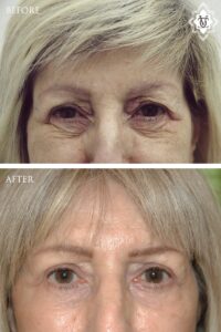 Blepharoplasty-12
