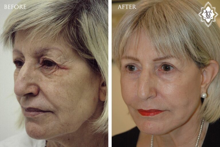 Facelift -2