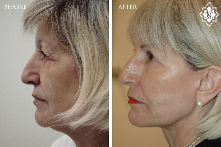 Facelift-3