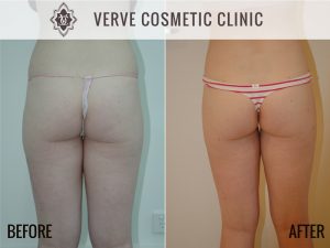 Liposuction - 1
