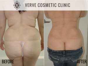 Liposuction 2