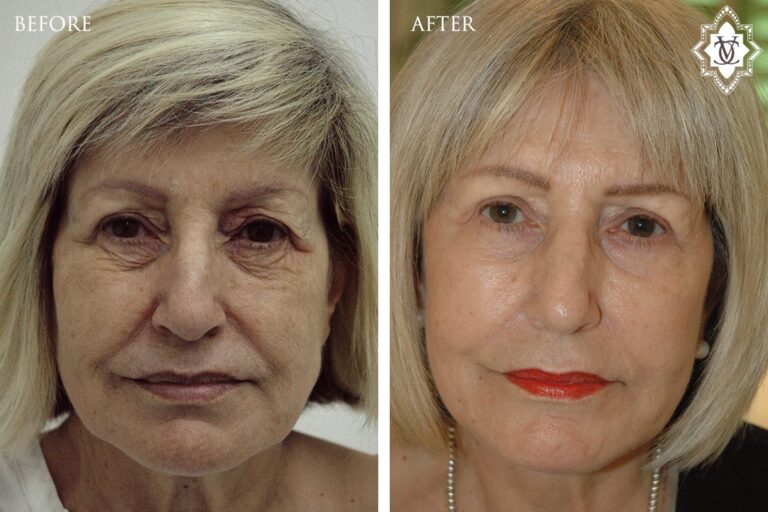 Pearl Fractional Resurfacing 1l