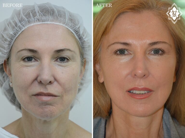 Thread Lift 1