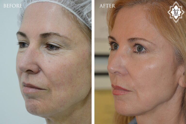 Threadlift 5